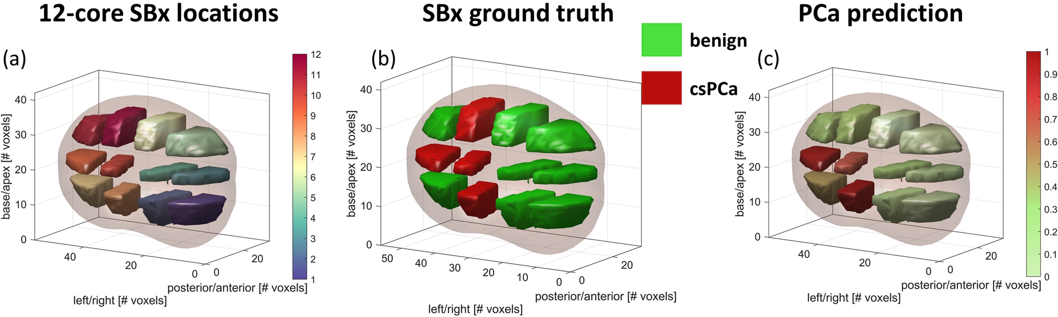 Three prostate models showing systematic biopsy locations, benign and clinically significant cancer findings, and predicted cancer probability.