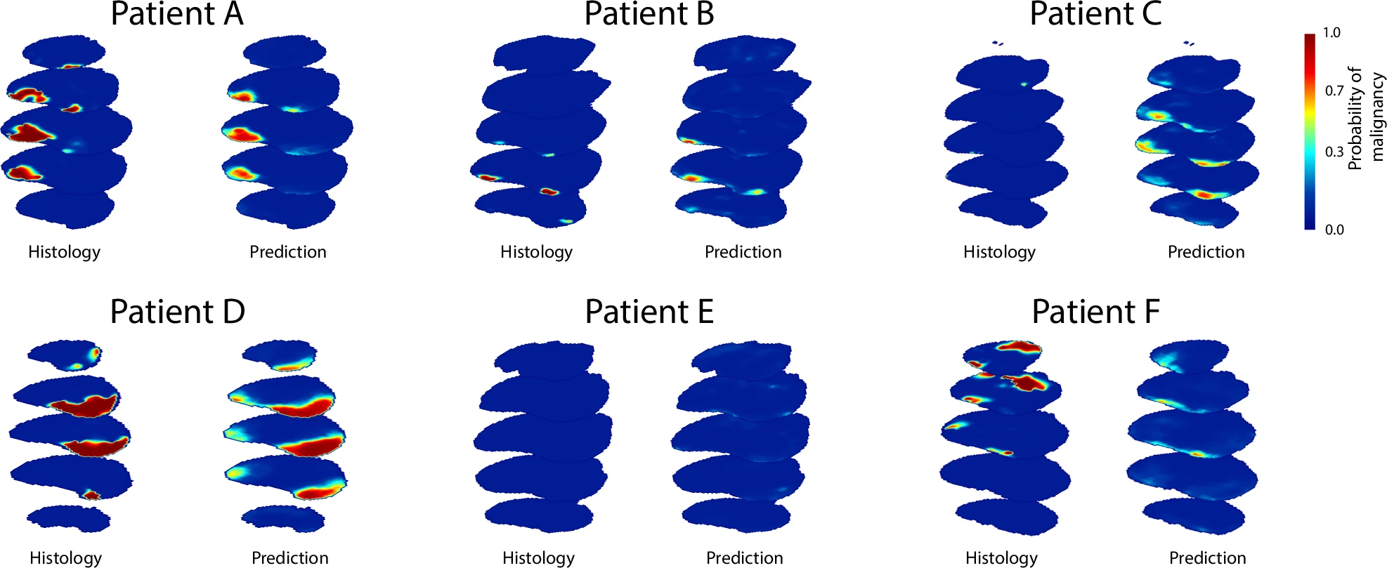 Histology and predicted cancer-probability maps displayed side by side for six example patients.