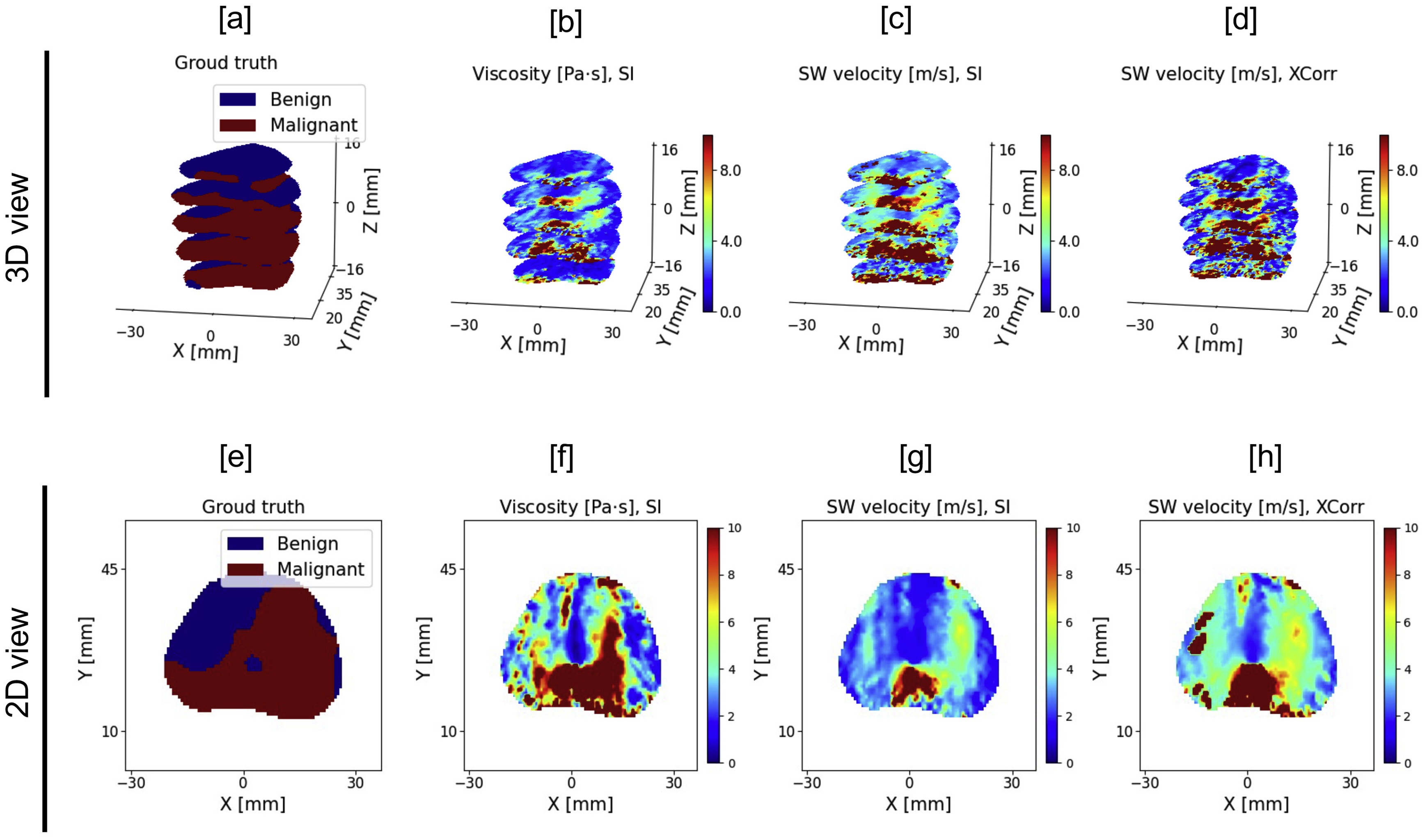Three-dimensional and cross-sectional prostate maps comparing benign and malignant histology with viscosity and shear-wave velocity estimates.